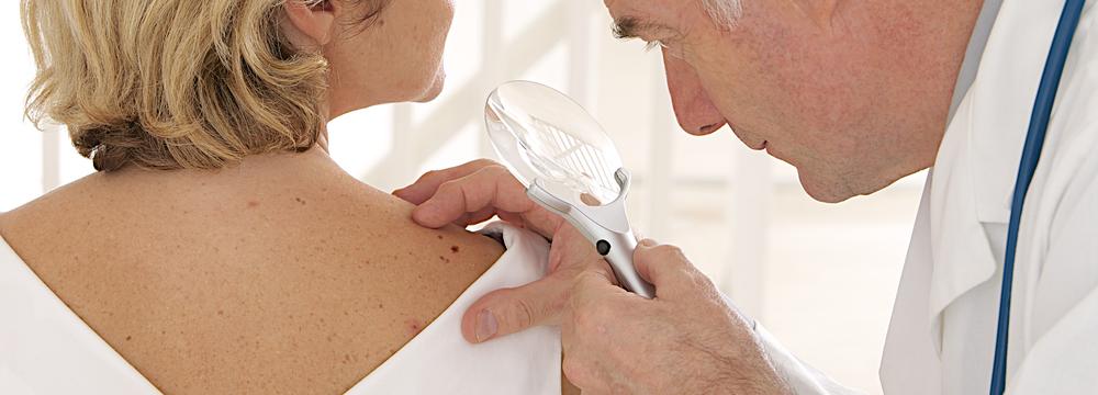 Pravidlo ABCDE: Naučte se ho, pomůže vám včas odhalit nebezpečí rakoviny kůže