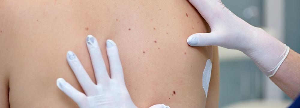 Proč nepodceňovat péči o pleť a kontrolu u dermatologa po dovolené?