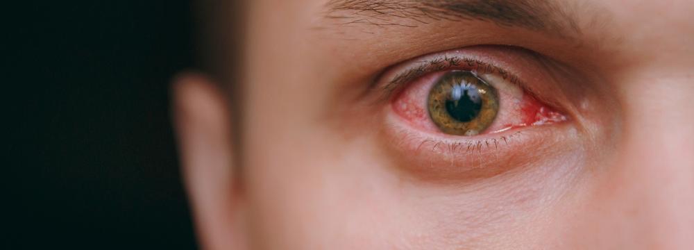 Svědění očí jako příznak nakažení variantou omikron