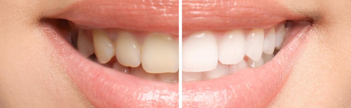 Jaké návyky způsobují žloutnutí zubů? Možná budete překvapeni