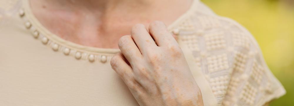 Sluneční paprsky a pigmentové skvrny. Jak vhodně chránit svou pokožku?