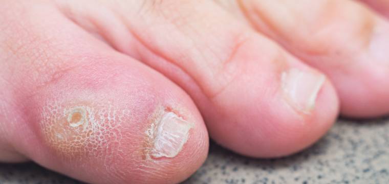 Bolestivé kuří oko – jak ho rozeznáte od mozolu či bradavice?