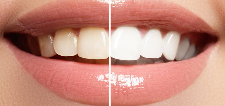 Bělení zubů: přehledné srovnání bělení doma, přírodně a u profesionálů