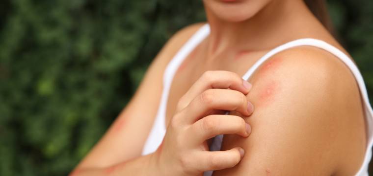 Babské rady na štípance, spálení i unavené oči od slunce