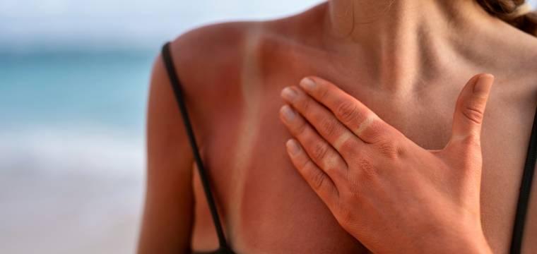 Jak nejlépe ošetřit spálenou pokožku? Pomůže tvaroh, okurka nebo aloe vera