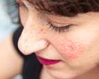 Nepříjemné svědivé pupínky na obličeji možná značí růžovku. Co to je a jak jí léčit?