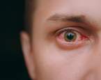 Svědění očí jako příznak nakažení variantou omikron